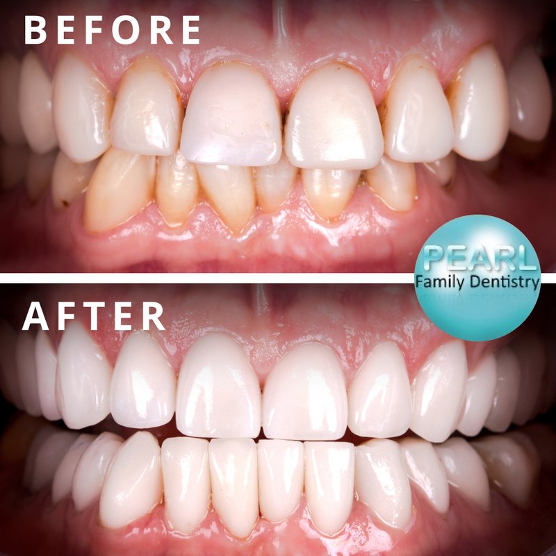 Clear Correct Aligners Patient Before and Afters - McOmie Family Dentistry